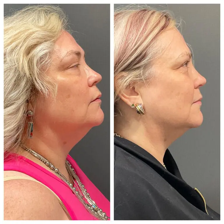 Before and after 3rd tx M8 Face and Neck