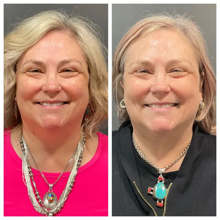 Before and after 3rd tx M8 Face and Neck