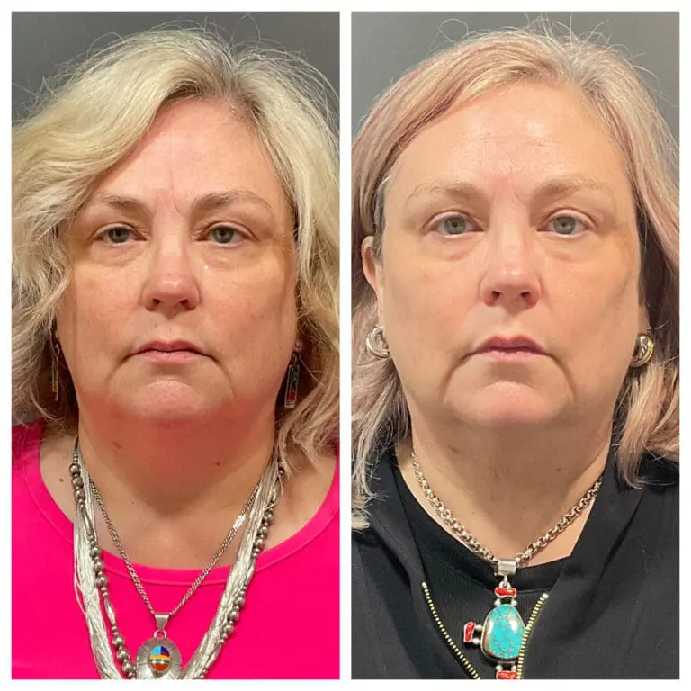 Before and after 3rd tx M8 Face and Neck