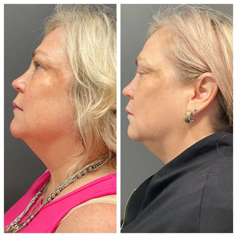 Before and after 3rd tx M8 Face and Neck