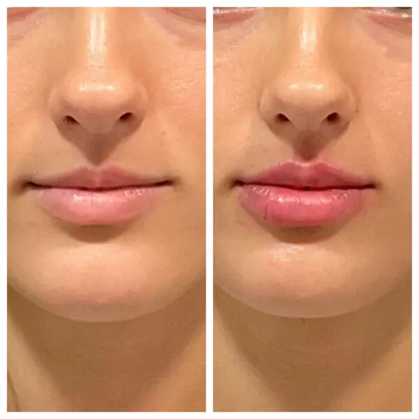 Before and Immediately after lip hydration 1/2 syringe