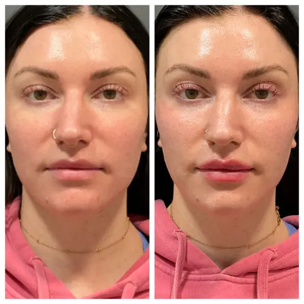 After Lip Filler 1 syringe and Cheek Filler 1/2 syringe