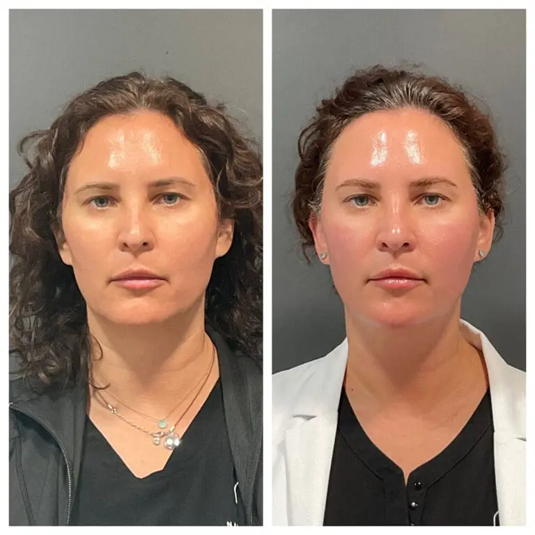 Immediately after HiFu #2