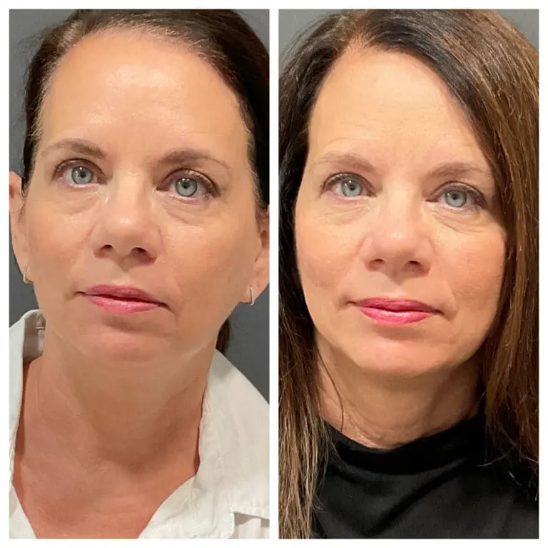 Before treatment and 2ks after 3 treatments