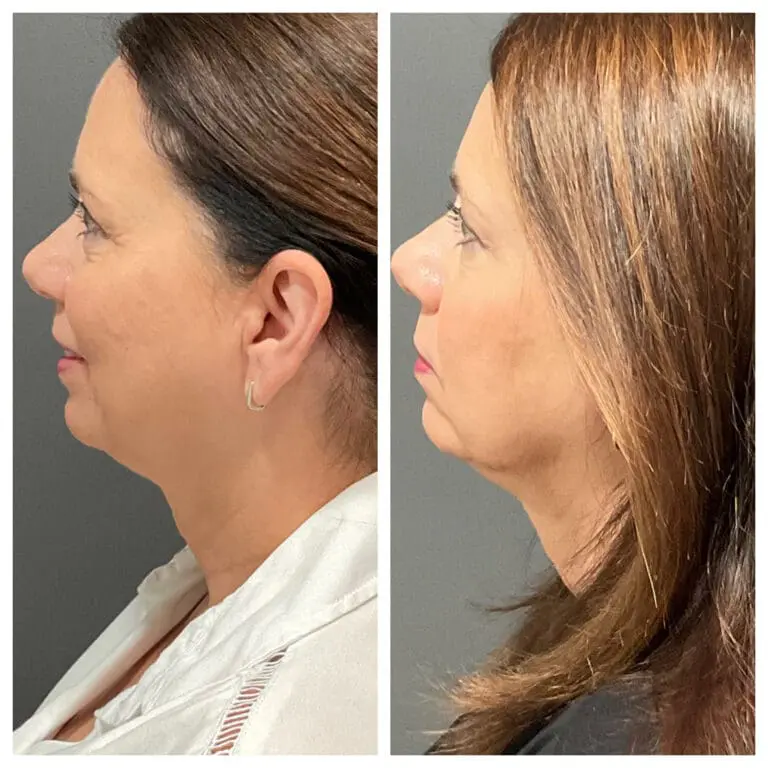 Before treatment and 2ks after 3 treatments