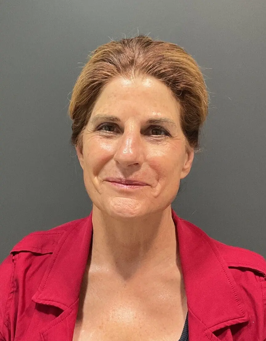 after 4 e1745517156817 | Naturally You Medical Spa