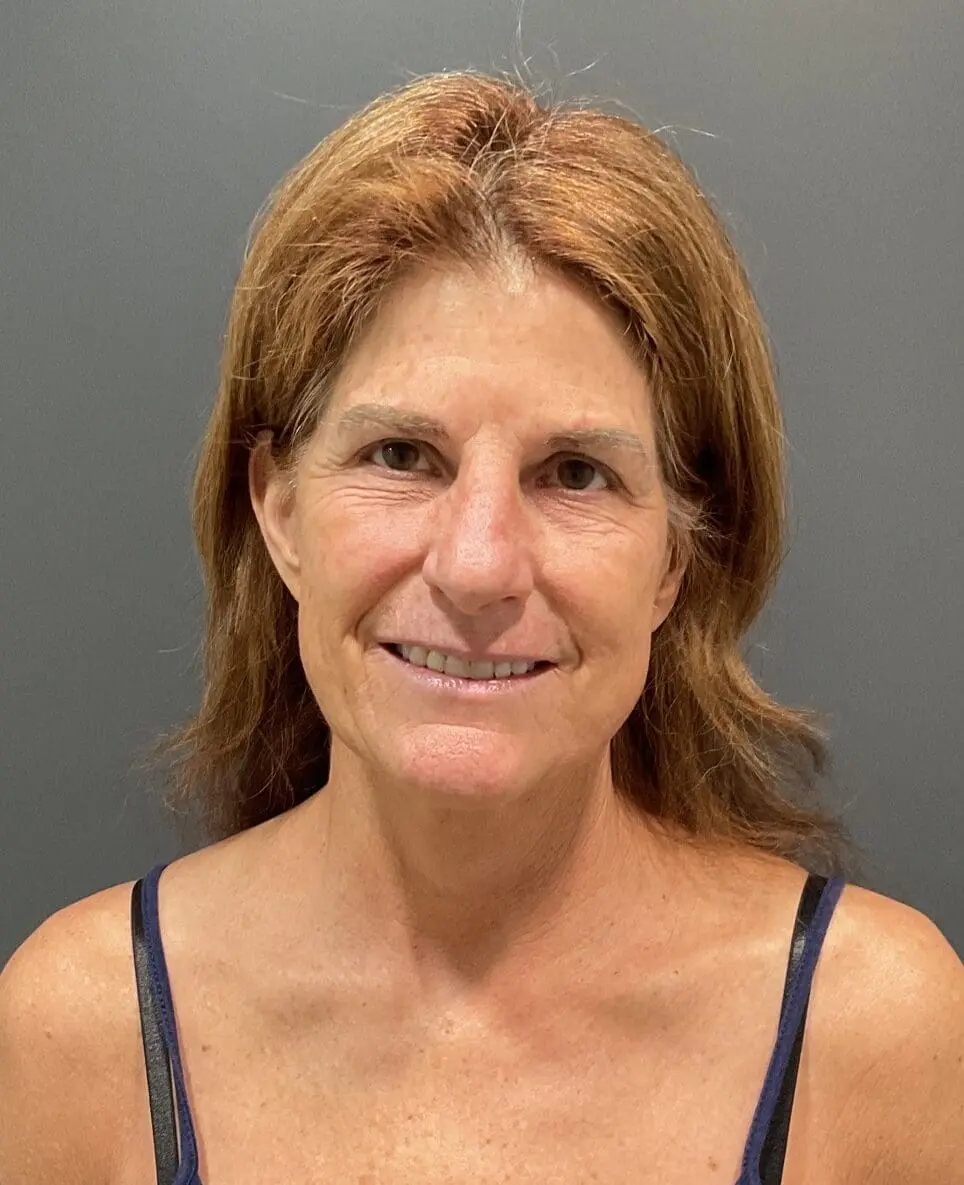 before 3 e1745516937788 | Naturally You Medical Spa