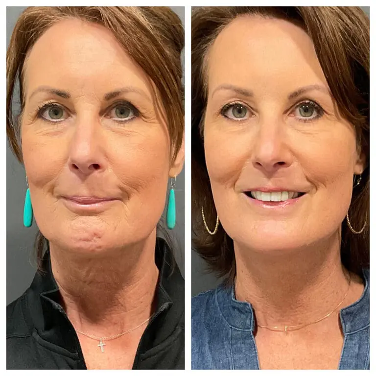 Before and After Total Look and Cheek filler