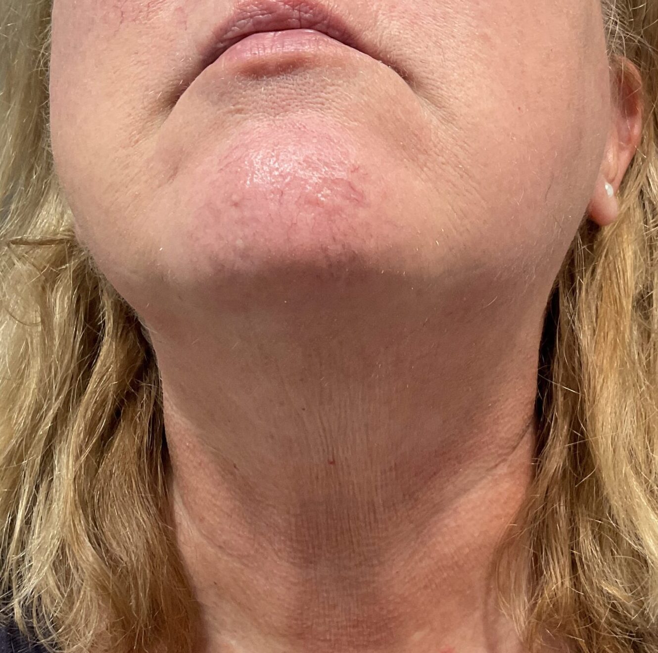 after 1 scaled e1745510397275 | Naturally You Medical Spa