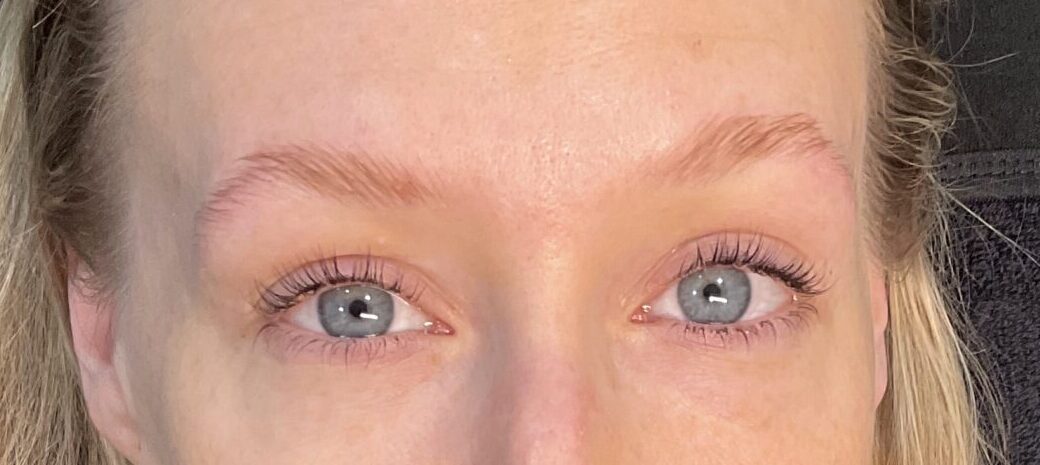 after 3 scaled e1745514565200 | Naturally You Medical Spa