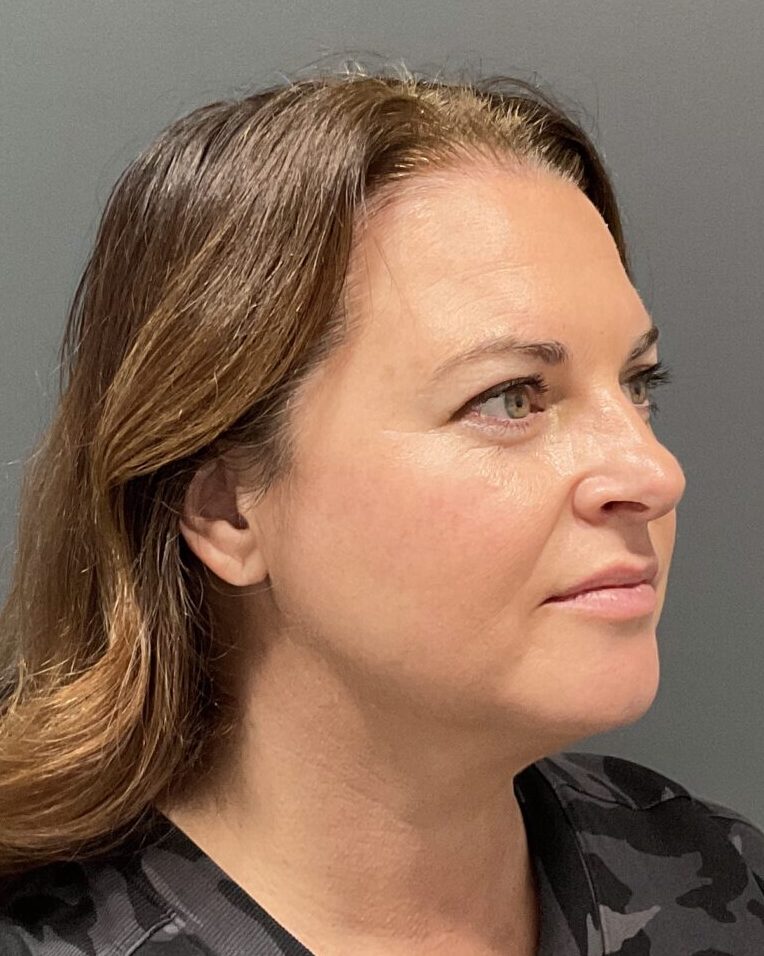 after scaled e1745426645616 | Naturally You Medical Spa