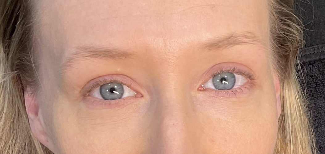 before 2 scaled e1745514542440 | Naturally You Medical Spa